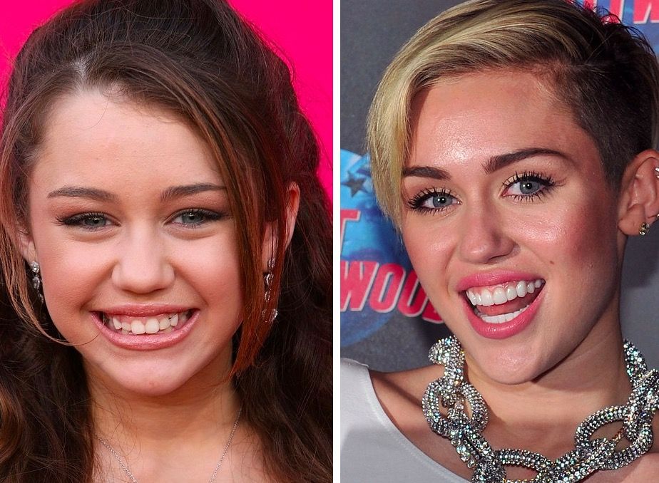 Miley Cyrus Teeth before after