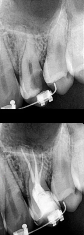 Root Canal Back tooth Premolars