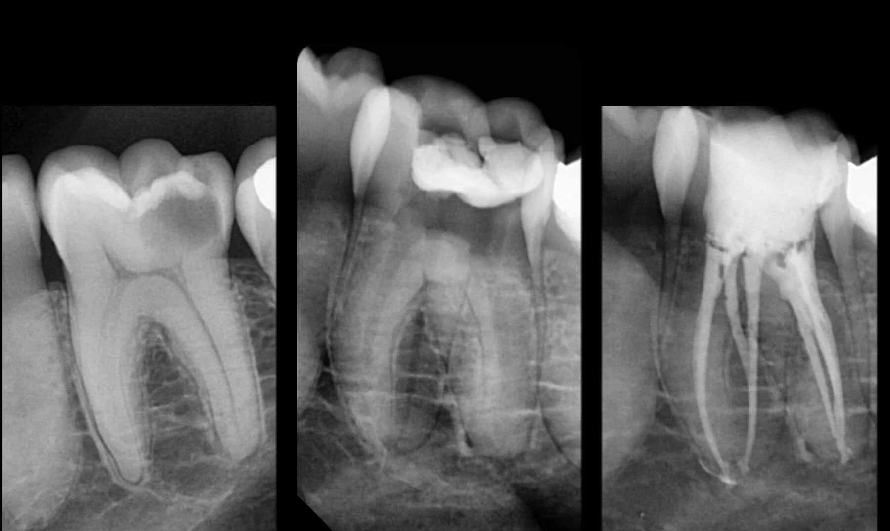 Root Canal back tooth Molar
