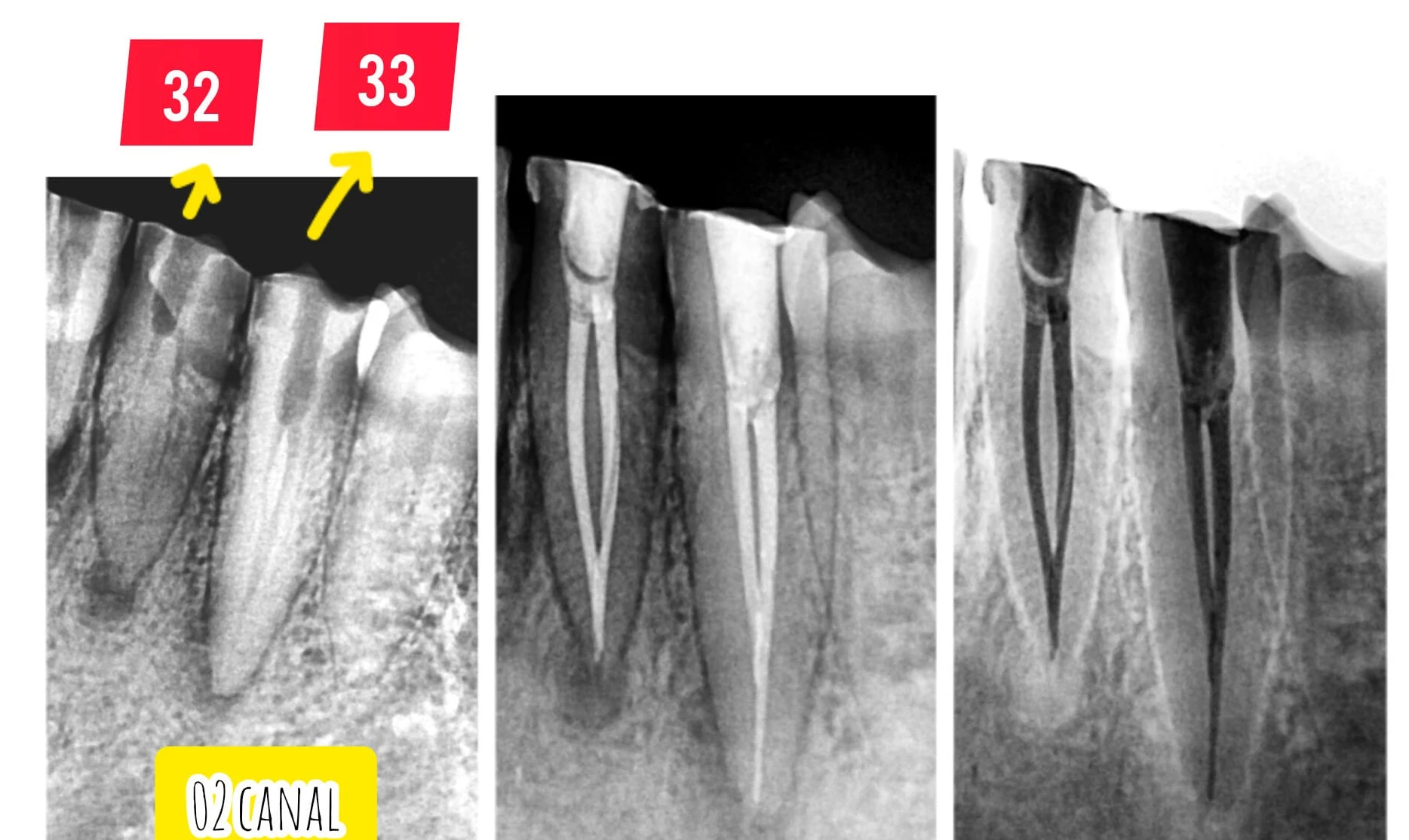 Root Canal Before After Front Tooth